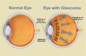 Eye Gloucoma New New