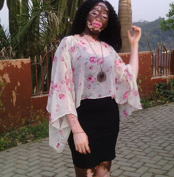 Enam Honya, nurse and Vitiligo Advocate in Ghana