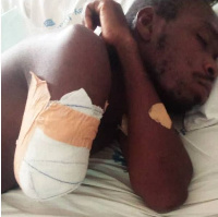 The arm of Felix Kwame Nortey has been amputated at St. Joseph’s Hospital