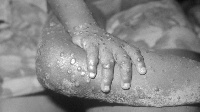 Na US CDC wey confam di new monkeypox infection