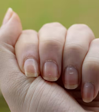 White Spot On Nails