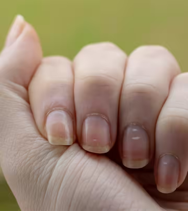 White Spot On Nails