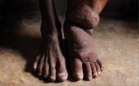 Lymphatic Filariasis