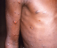 GHS has debunked claims of two confirmed cases of monkey pox in the central region