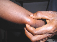 Health authorities fear the NTDs can take the Region by storm if not given the needed attention