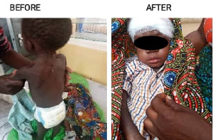 A child that has recovered from malnutrition