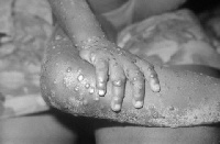 File photo/ Monkeypox