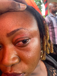 Dzifa Kaledzi's injured left eye