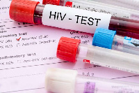 File photo of HIV test blood sample