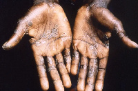 Ghana has not recorded Monkeypox case