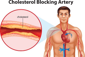 How Cholesterol affects the artery