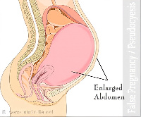 Pseudocyesis gives people a sense of false pregnancy