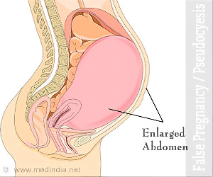 False Pregnancy Kkdhheo