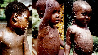 File photo of children with monkeypox