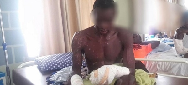 Nashidu Ayoka lost four fingers and had parts of his body severely burnt in an explosion at the site