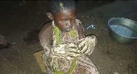 Eight-year-old whose hands were boiled by her mother