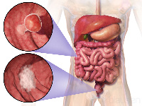 Bowel cancer fit start for di colon (large bowel) or di rectum (back passage)