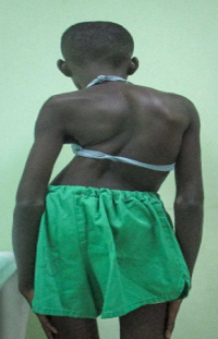 A patient suffering from a complex spinal and orthopedic condition