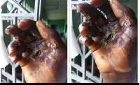 File photo of a person's burnt hands