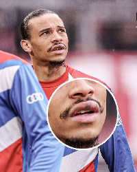 A photo of Leroy Sane's swollen lip