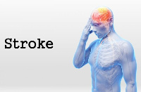 Stroke is caused by many factors