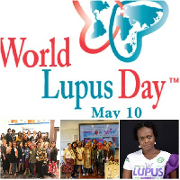 Lupus is a chronic autoimmune disease that affects at least five million people worldwide