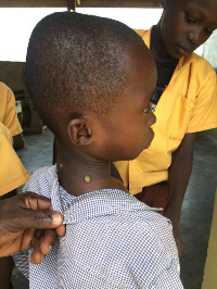 Some students of Badukrom SDA School have been infected with yaws disease