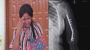 Priscilla lost her arm during a fatal accident and has had to live with a metal bone implant